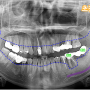 신당동 치과 오랜 기간 염증이 계속해서 남아있는 경우에는 치조골을 소실시켜 임플란트 식립이 어렵게 될 수 있습니다.