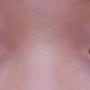 안검하수 비절개 눈매교정 도르래 쌍수- 쌍꺼풀 수술 3년차 무보정 전후 후기 (붓기,멍,부작용 등)