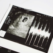 시험관 임신초기 증상 5주차, 6주차, 7주차 초음파 심장소리 아기집 난황 보이는 시기