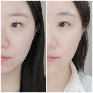 울쎄라600 받으러 갔던 얼굴피부탄력과 이중턱 효과 한달 후기