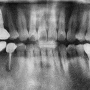 하남시청역 치과 심한 치아우식으로 인한 자연치 기능 상실! 임플란트 식립을 통해 개선해 드린 이야기