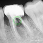안양역 치과 에서 편안한 임플란트 수술 받는법(포스트의 쐐기효과?)