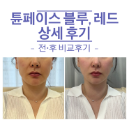 얼굴주름리프팅 튠페이스 블루 레드 LDM 관리 효과 전후비교 상세후기