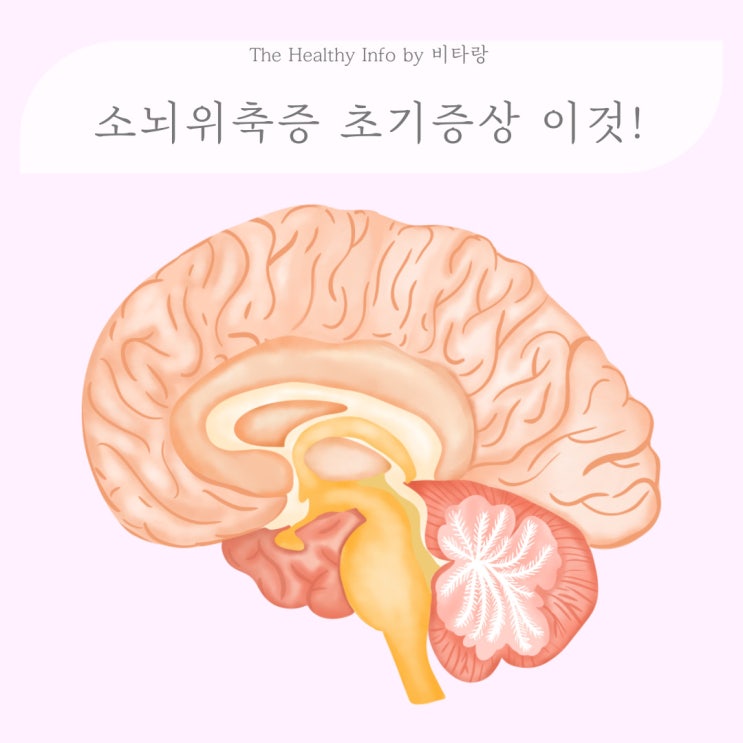 소뇌위축증 원인 초기증상 전종서 아버지 : 네이버 블로그