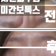 부산서면피부과 미간보톡스 후기 + 정보