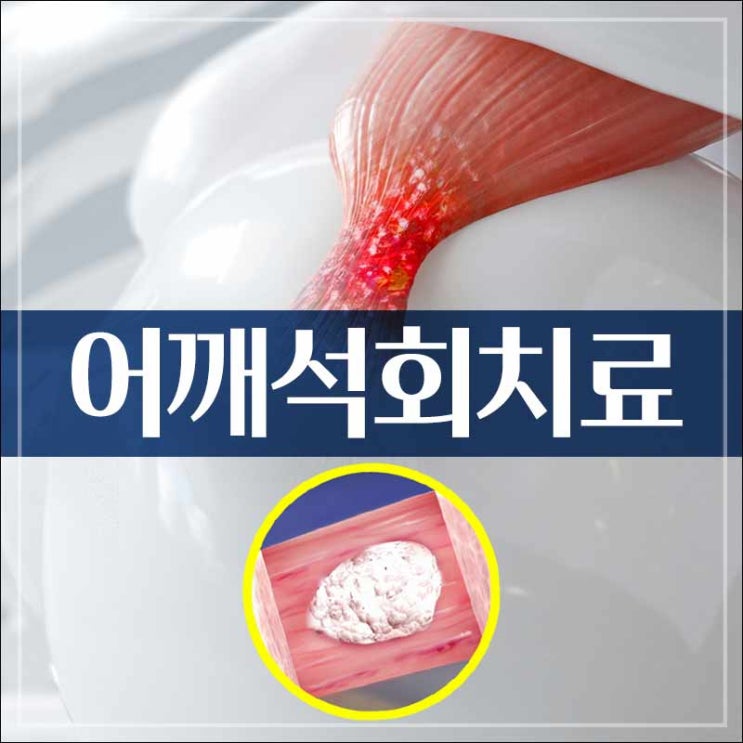 부평어깨 석회 치료 좀처럼 낫지 않을 때 제거 방법은? : 네이버 블로그