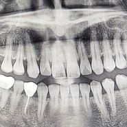 2. 치아교정 방법 고민