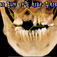 대학병원 의뢰 된 큰 크기의 치근단 낭종 잇몸 물혹 임플란트 치료 가능할까 전신마취 없이 국소마취 로 인천 부평 구강외과 치과 에서 해결해요