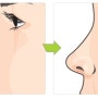 낮은코 작은코와 동반되는 짧은 코 길이 늘리기✔️ 짧은 코 수술에 쓰이는 연골은?