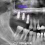 성남 치과 치조골 소실 심한 어금니 치아 상악동 거상술(crestal approach) 활용 발치 후 디지털 임플란트 식립