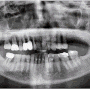 옥정신도시치과 72세 치주질환으로 인한 치아 소실 케이스