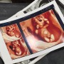 임신 11주차 | 1차 기형아 검사 (니프티 검사 추가진행), 임산부 입술 포진