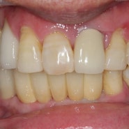 성남 임플란트 치과 구강 상태에 따른 안전한 치료