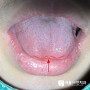 광남동 치과 설소대 성형술. 아이 혀가 짧으면 꼭 수술해야되나요?