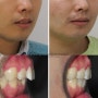 비발치 미세돌출 치아교정 변화