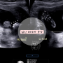 [임신20주차증상] 서울여성병원 정밀초음파검사 태동이 눈에 보이는 시기 임신중기빈혈 배통증