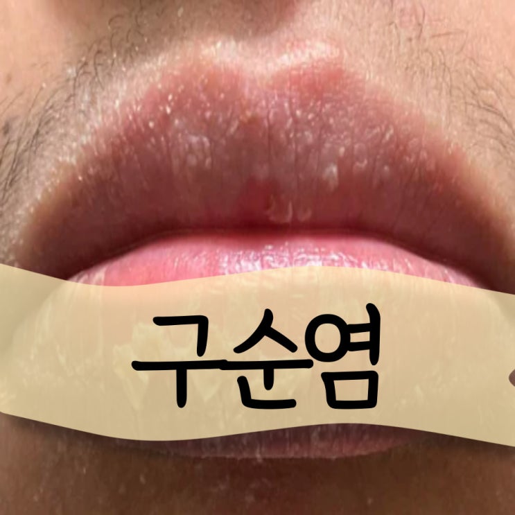 박탈성 구순염 입술 연고 효과 보려면 : 네이버 블로그