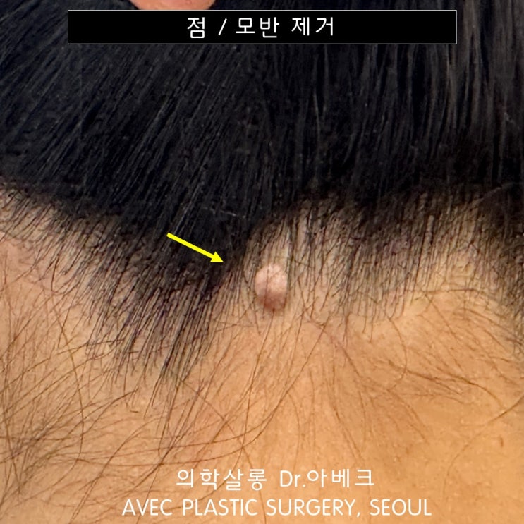 버섯 같이 생긴 혹 제거, 섬유종일까? 모반/점일까? 【Dr. 아베크 점/모반】 : 네이버 블로그