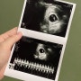 임신 7주차 피비침 증상 초음파 심장소리