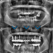 십정동임플란트, 다수의 어금니 식립으로 안정적인 교합높이 회복