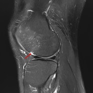 젊은 남자 무릎통증: 골연골결손