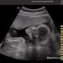 임신일기9 ::: 20주차, 기형아검사 저위험군 확인 그리고 입체 초음파