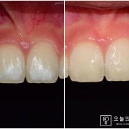 신중동 치과 에서는 치아 반점치 를 미백, 레진 두가지로 완벽하게 해결해드립니다.