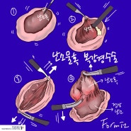 난소 물혹 터짐 증상 기능 보존하려면 빨리