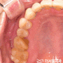 이빨 깨짐 방치하면 뿌리 까지 부러져요. 성남 치과 발치 후 상악동 뼈이식 후 디지털 임플란트 수술