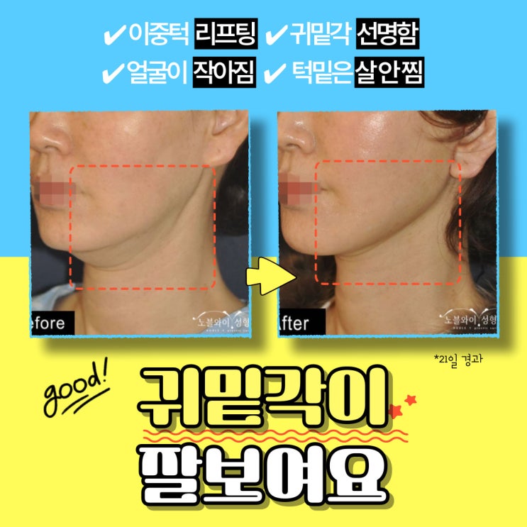 이중턱살제거 수술 과정과 회복 tip : 네이버 블로그