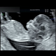 임신12주~13주차, 아름제일 기형아검사 1차, 니프티검사
