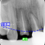 신당동 치과 부러진 치아는 임플란트 를 심어 개선할 수 있습니다.