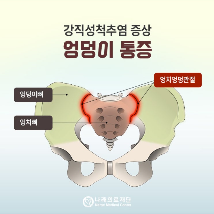 엉치엉덩관절 염증성 요통, 강직성척추염 증상 및 검사 [ 허리MRI ] : 네이버 블로그