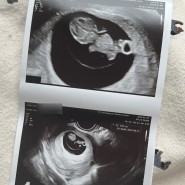 부부일기 - 임신 편 #2 (임신 초기 7주~12주)