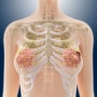 아산암재활요양 유방암 뼈전이 증상 회복을 위한