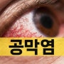 상공막염 공막염 원인 증상 및 한의원 치료, 눈염증 눈충혈 눈통증