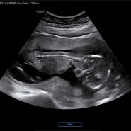 임신15~16주차) 임산부감기 임산부감기약 임산부수액 2차기형아검사 태아성별확인 임산부회