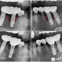 고산동 치과 는 다른 곳에서 심었던 임플란트 재식립(재수술) 도 가능합니다.