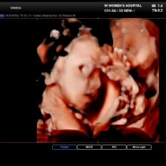 임신24주 임당검사 & 정밀초음파 대전 더블유여성병원