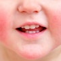 봄, 여름 아기 피부 가려움증 관리 / 기저귀접촉성 피부염, 침 발진, 아토피피부염 치료와 예방
