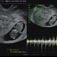 [시험관 기록] 임신 9주 6일 초음파 / 하단 이룸 난임병원 졸업