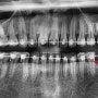 문형동 치과 : 교정 치료 중 꼼짝않는 유착 매복치 어떻게 할까요?