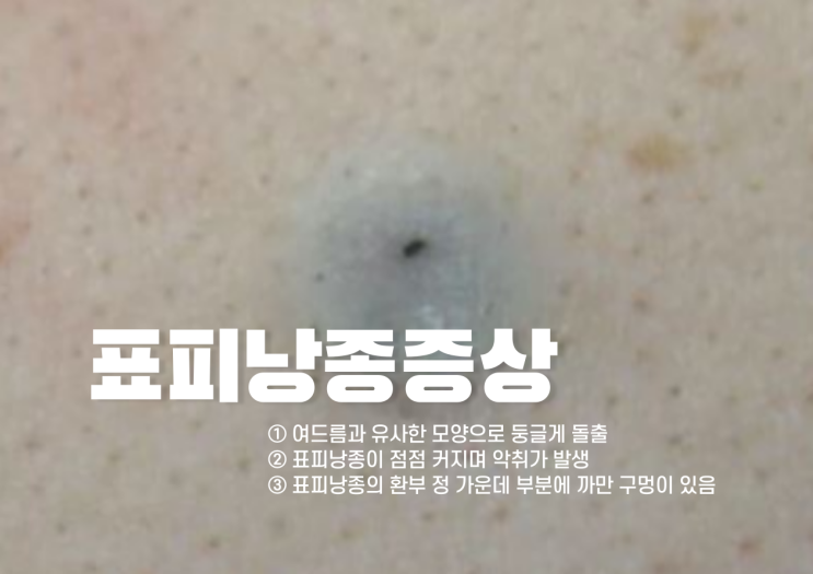 표피낭종 원인과 증상 (ft. 피지낭종) : 네이버 블로그