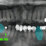 동탄역 치과 자연치 결손 및 골흡수 부위 임플란트 케이스