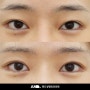 성공적인 눈재수술 방법 소개 (절개 쌍꺼풀 수술과 눈썹하거상) ㅣ 신논현 눈재수술