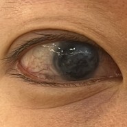 눈높이안과: 각막타투(각막문신) 사례 (부산 해운대 33세 환자)