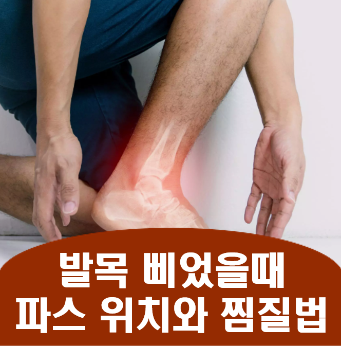 발목 삐었을때 파스 위치와 찜질, 빨리 낫는법과 회복기간 : 네이버 블로그