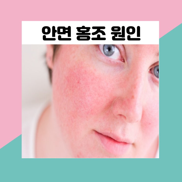 안면 홍조 원인 얼굴홍조 치료 예방 : 네이버 블로그