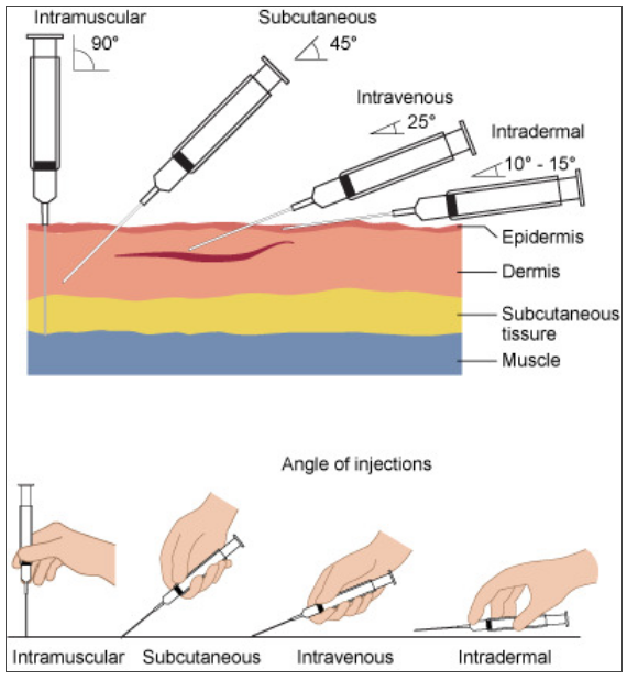 바늘 삽입 각도(Needle Insertion Angle) 및 제거(Removal) : 네이버 블로그