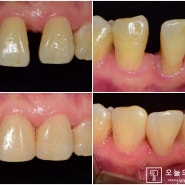 신중동 치과 레진접착기술과 예술적 감각이 모두 필요한 까다로운 앞니 레진 치료.